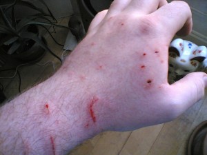 Human hand with cat bite injuries