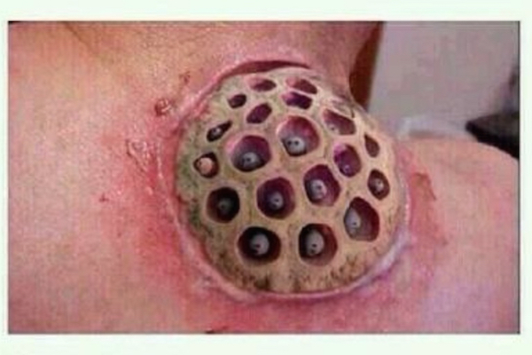 Head & Shoulders and Trypophobia Hoax Graphic
